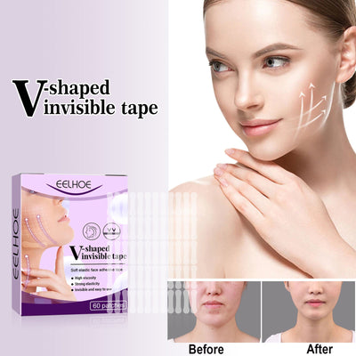 Invisible Lifting Patch for a Defined V-Face