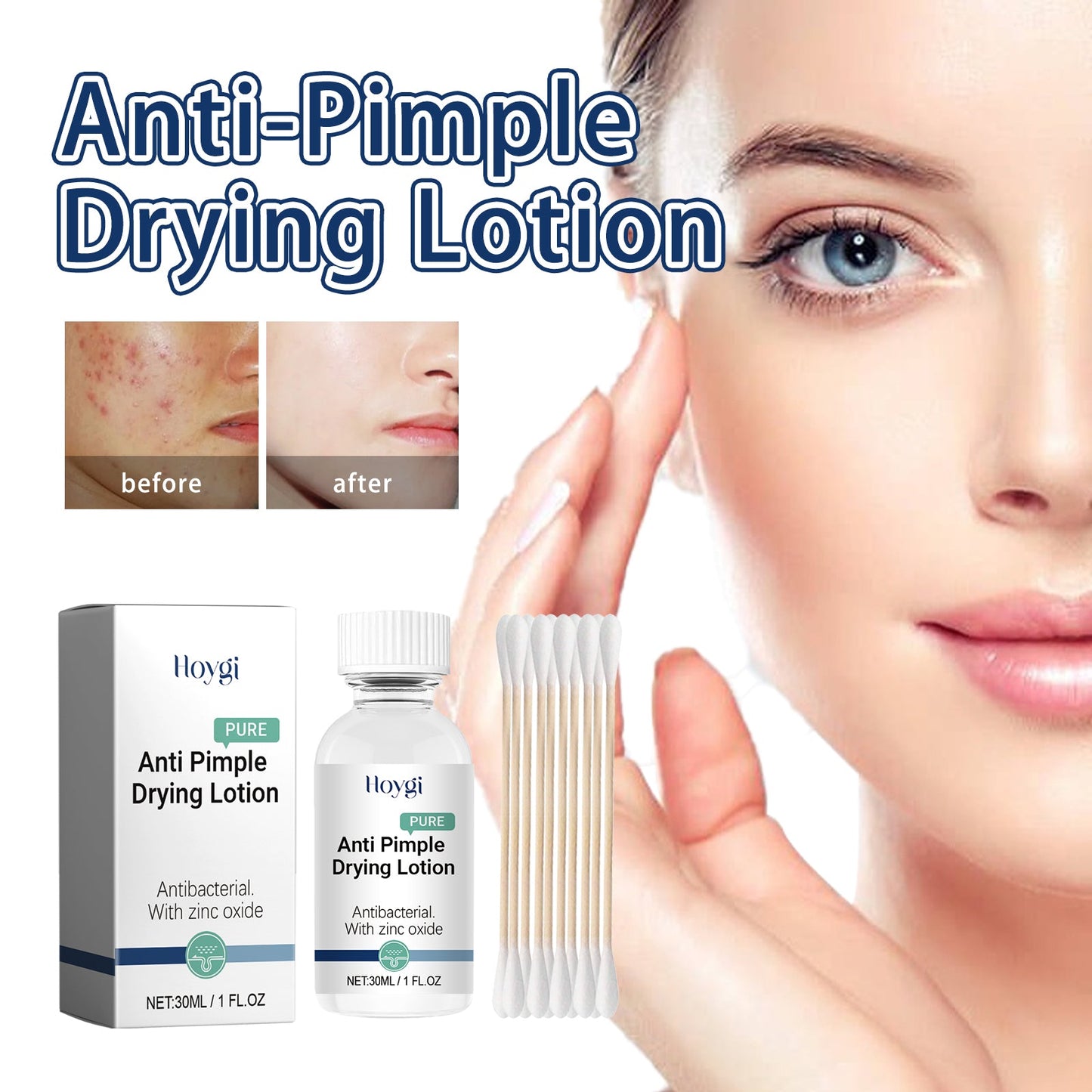 Anti-Pimple Drying Lotion, Facial Cleansing And Repair Lighten Acne Marks And Pits, Close Your Mouth And Mild Skin Cream - Korvel