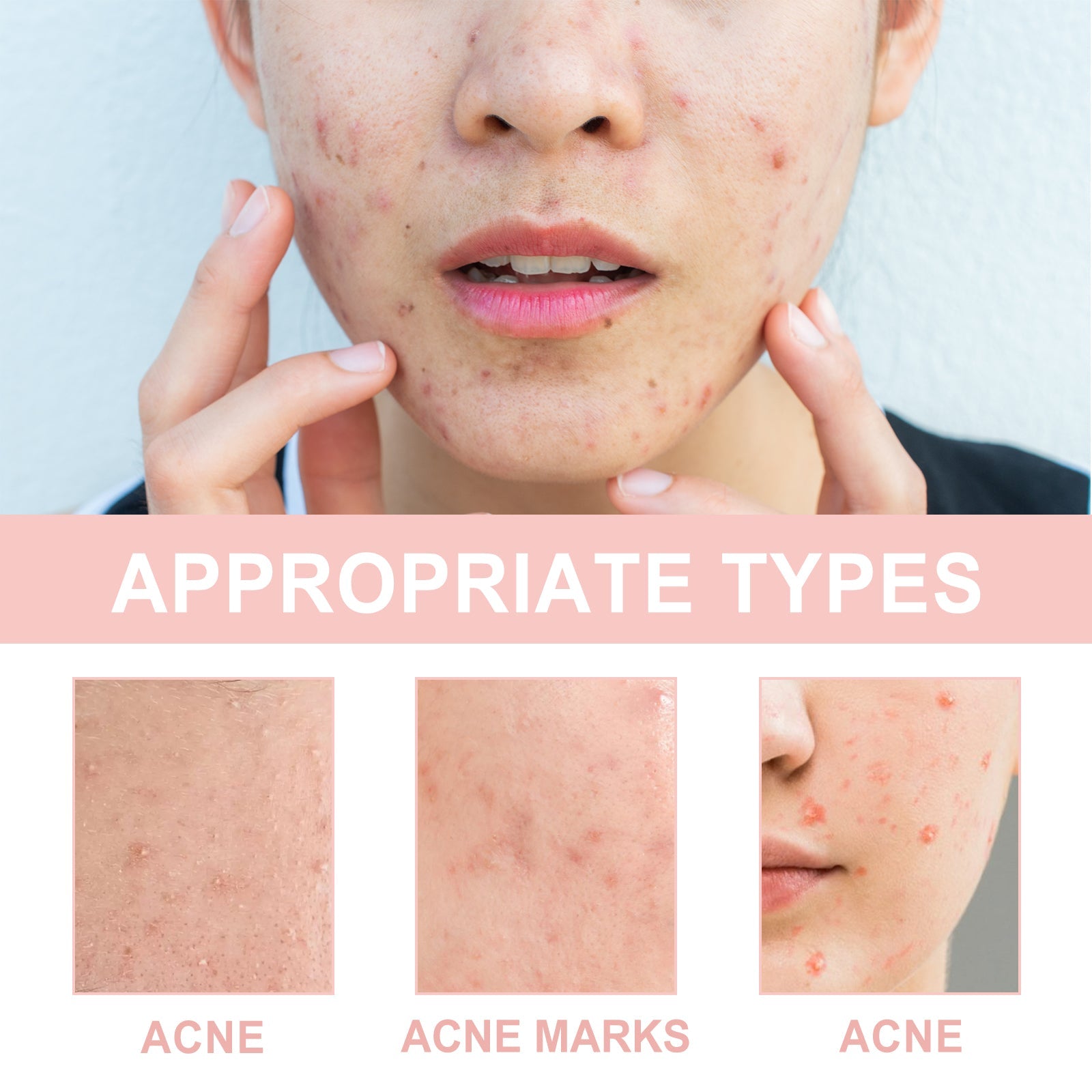 Acne Patch, Repair Acne Pimple Facial Redness Clean Pores Moisturize Skin Patch - Korvel