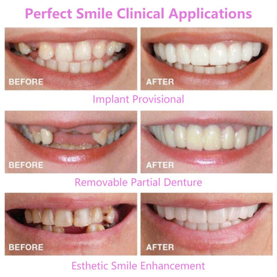 Upper Teeth And Lower Teeth Simulation Braces Non-Porous Braces Whitening Sleeves Second-Generation Silicone Simulation Teeth Dentures - Korvel
