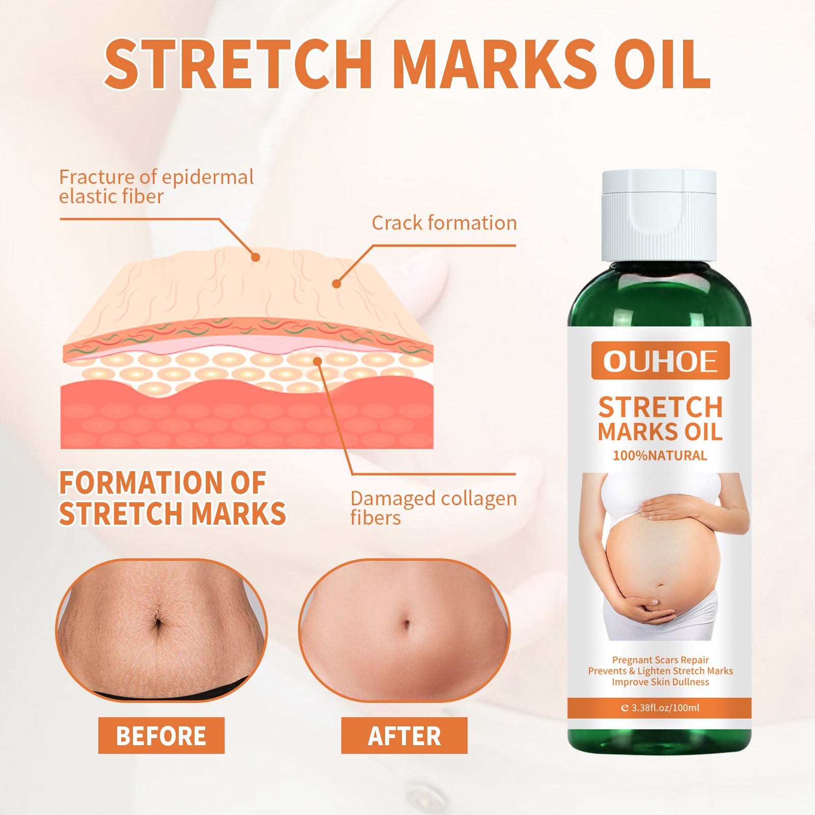 Pregnancy Massage Oil, Repair Pregnant Women Prenatal And Postpartum Stretch Mark Skin Care Massage Oil - Korvel