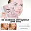 Sea Life Pattern Acne Patches, Lighten Acne Acne Repair Facial Skin Concealer Acne Patch - Korvel