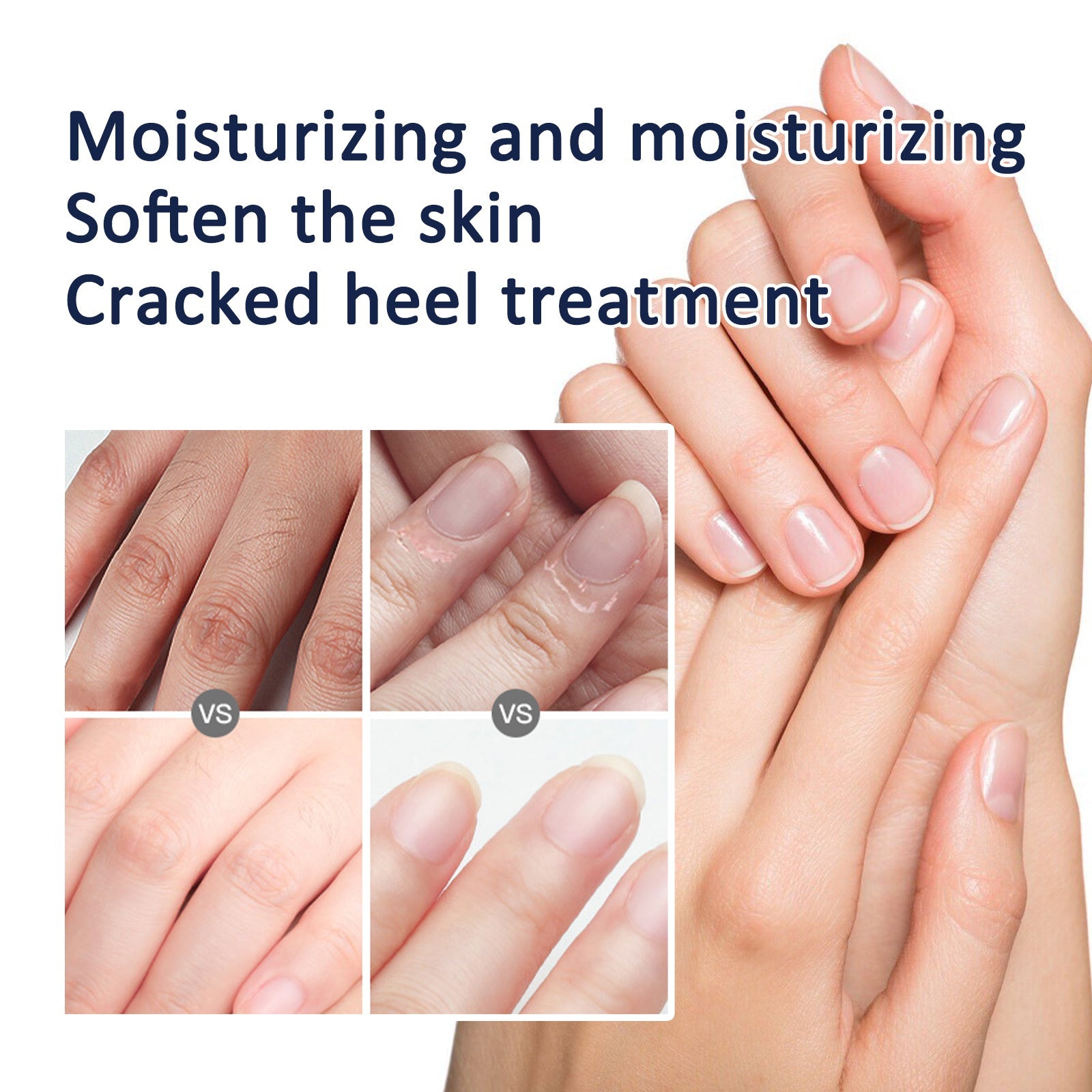 Anti-Crack Repair Hand Cream, Improves Cracked Rough Skin, Removes Dead Skin And Hydrates Hands And Feet Cream - Korvel