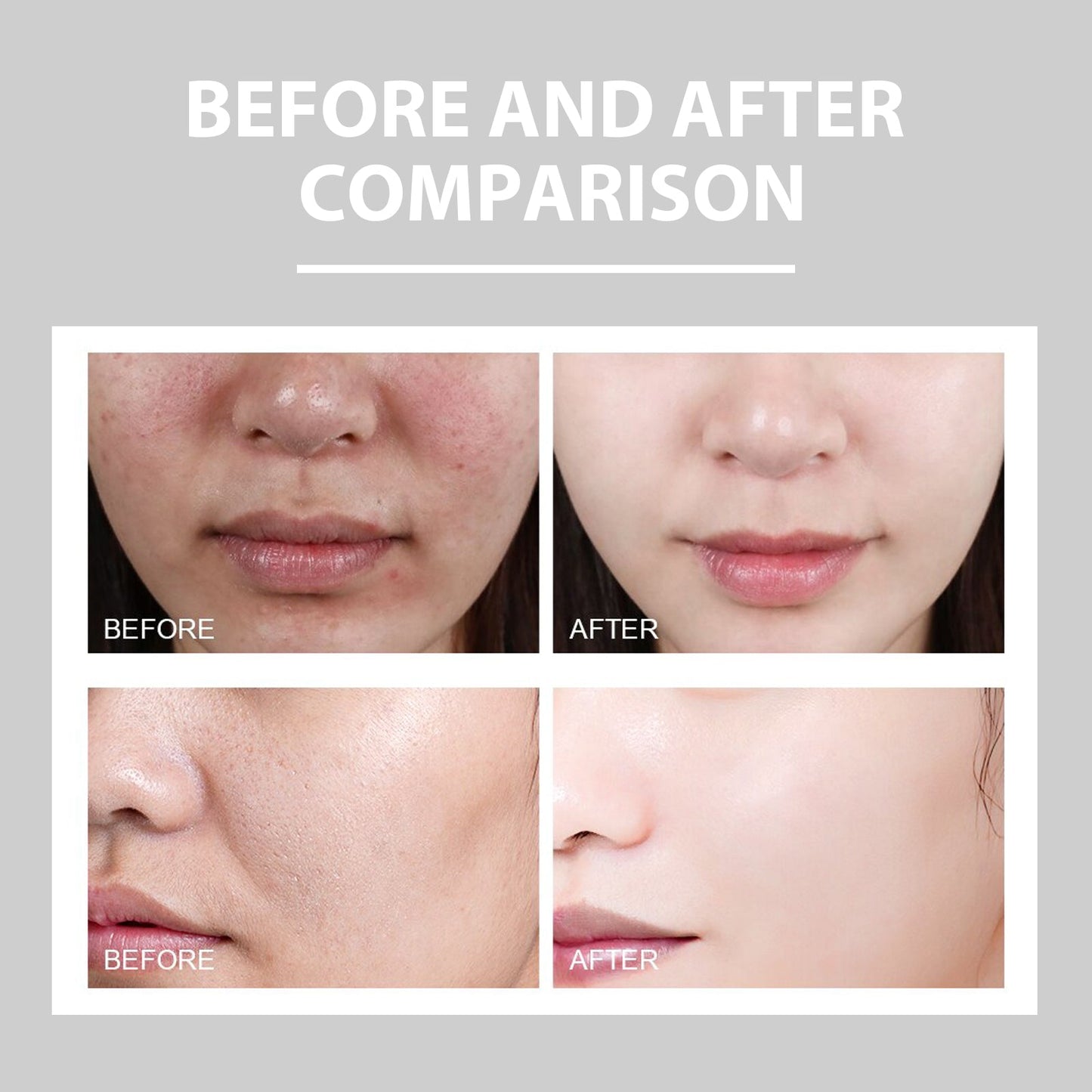 Hydrating Cream Hydrating And Lightening Facial Acne Repair Redness Hydrating And Brightening Moisturizing Cream - Korvel