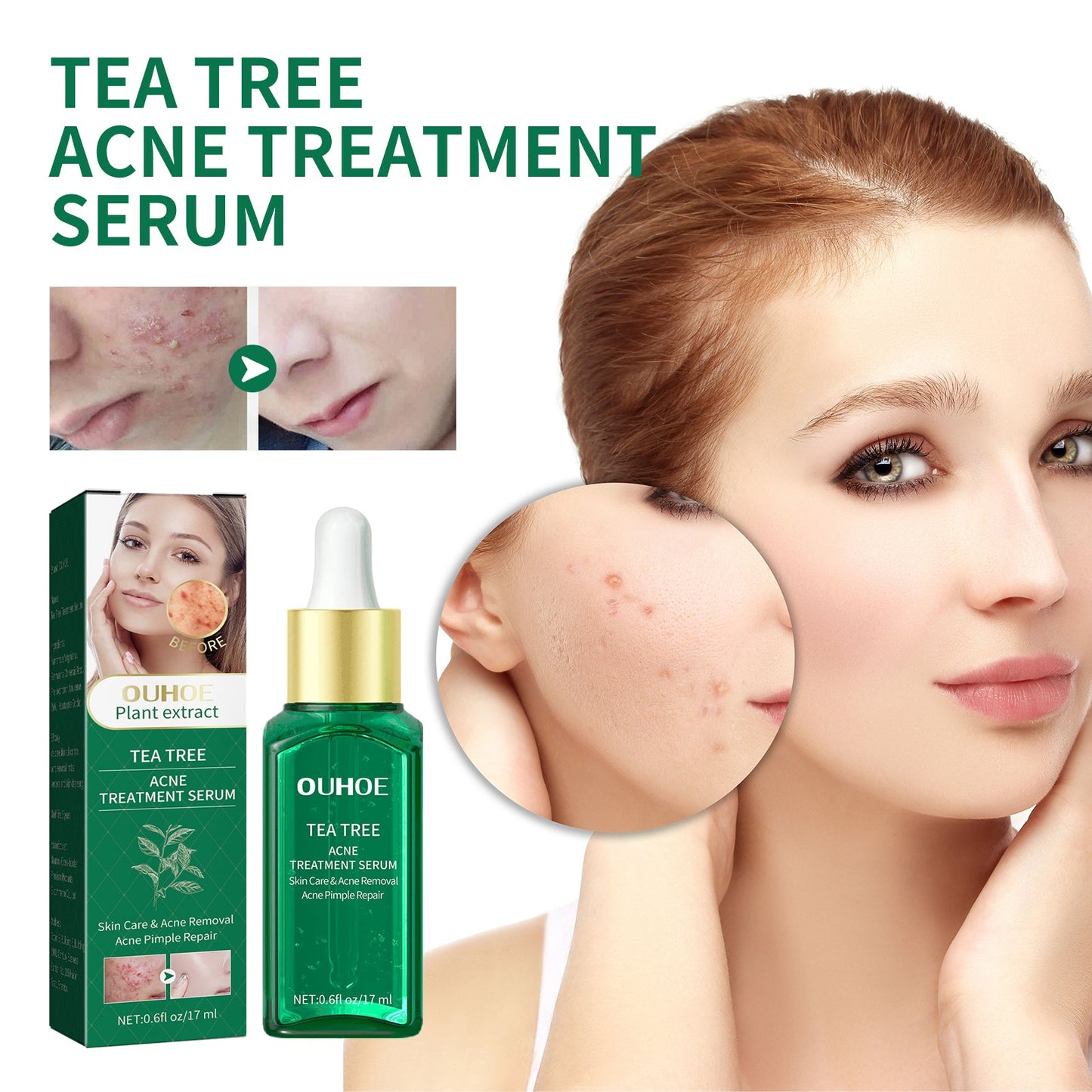 Tea Tree Oil Acne Serum, Remove Acne, Clear Acne, Repair Skin, Lighten Acne Printing Face Essence - Korvel