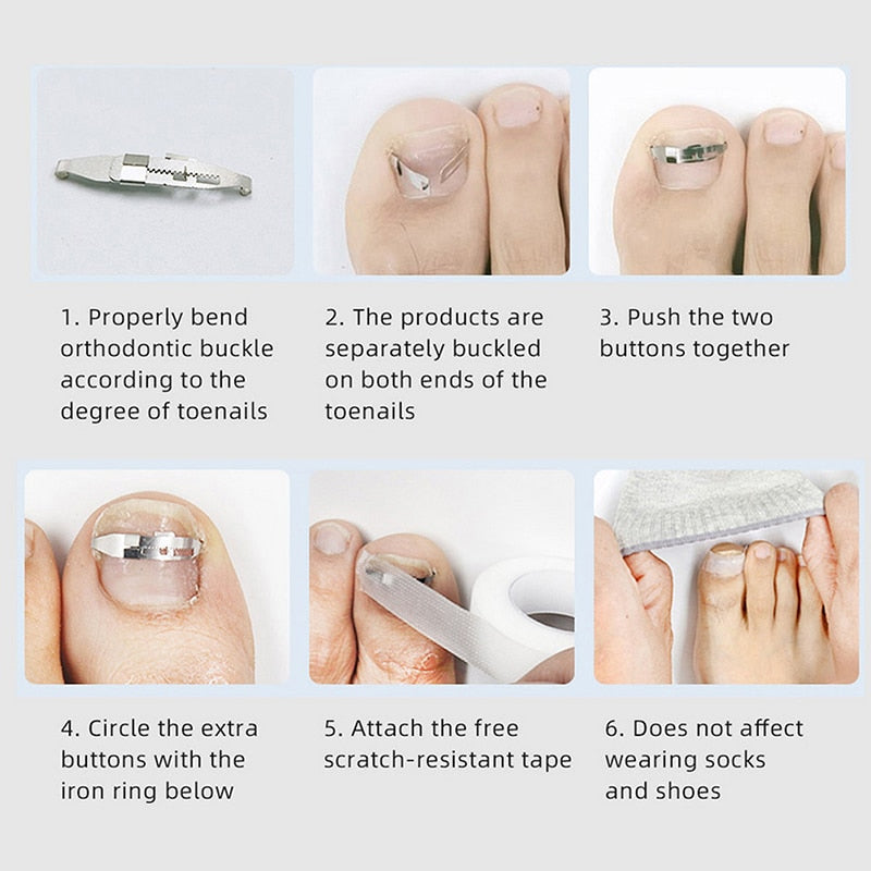 Ingrown Toenail Corrector Tools Pedicure Recover Embed Toe Nail Treatment Professional Ingrown Toenail Correction Foot Care Tool - Korvel