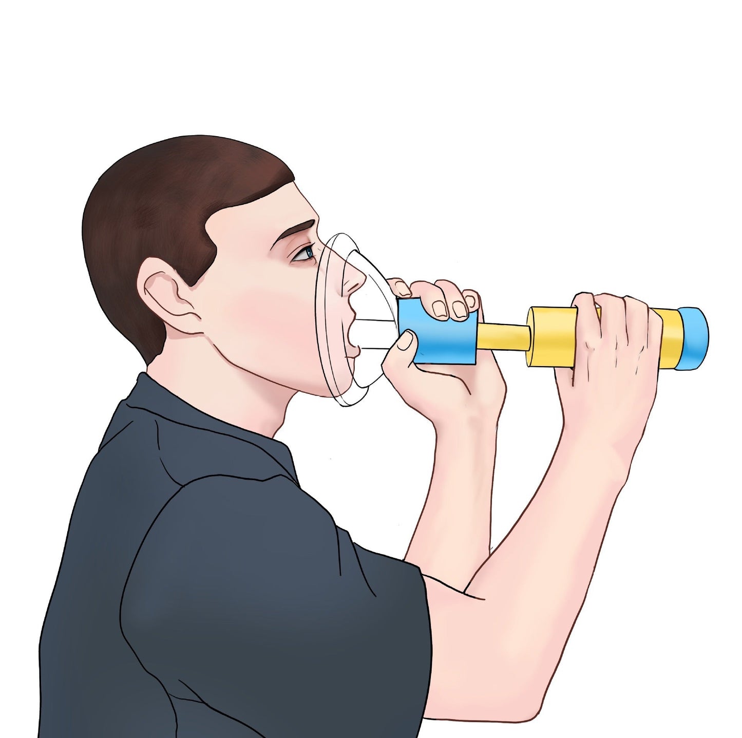 Portable Anti-Choking Device for Emergency Situations