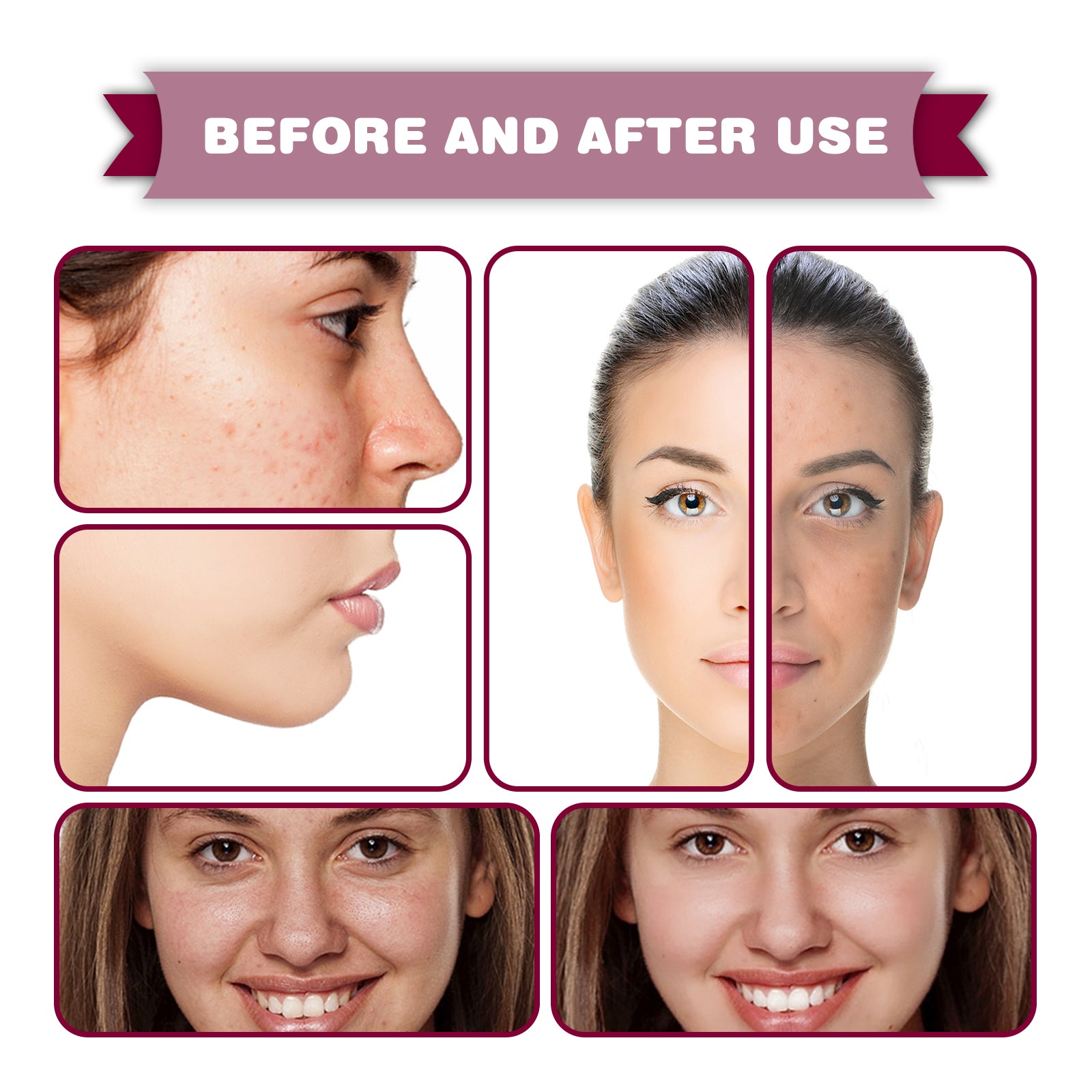 Acid Essence, Shrinks Pores, Removes Blackheads, Pimples And Acne Marks, Brightens Skin Tone Moisturizing Essence - Korvel