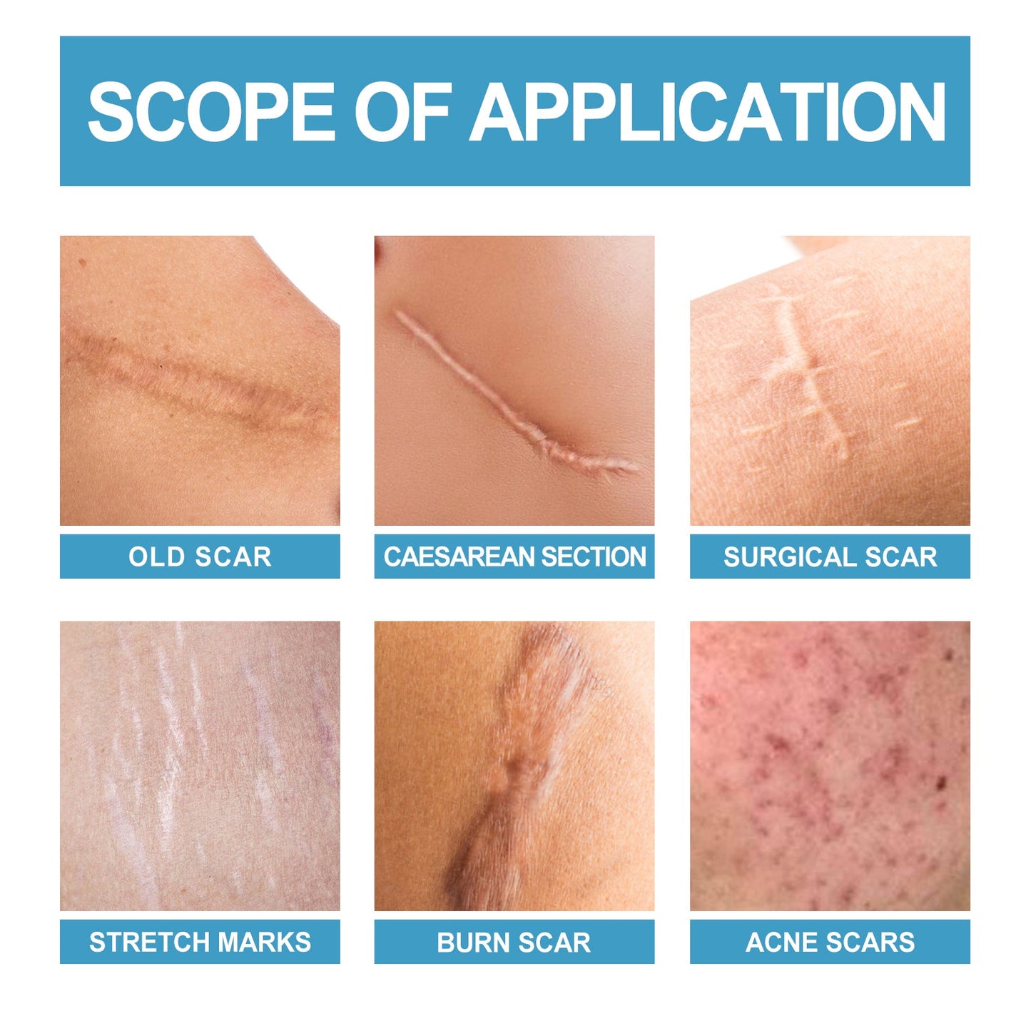 Scar Repair Serum Lightens Post-Pregnancy Scar Repair And Smoothes Body Skin - Korvel
