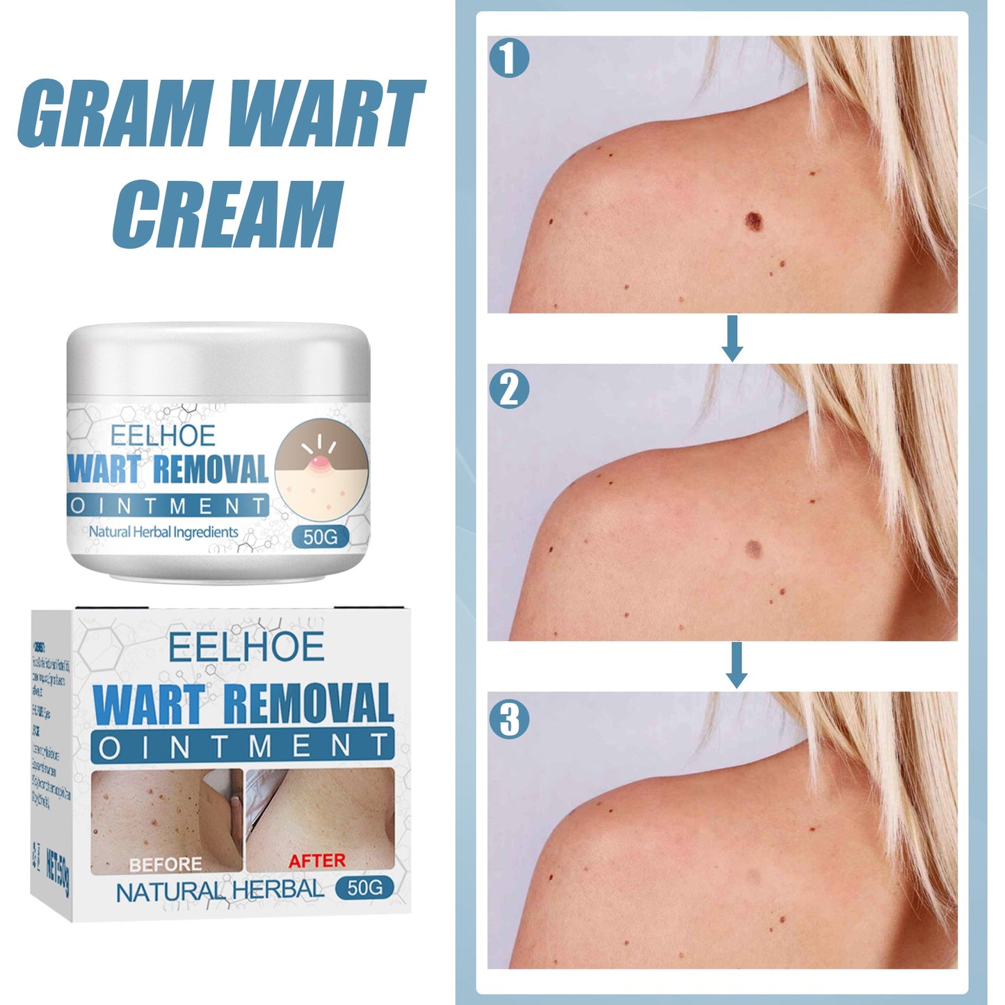 Crème Premium pour Verrues pour un Soin de la Peau Lisse