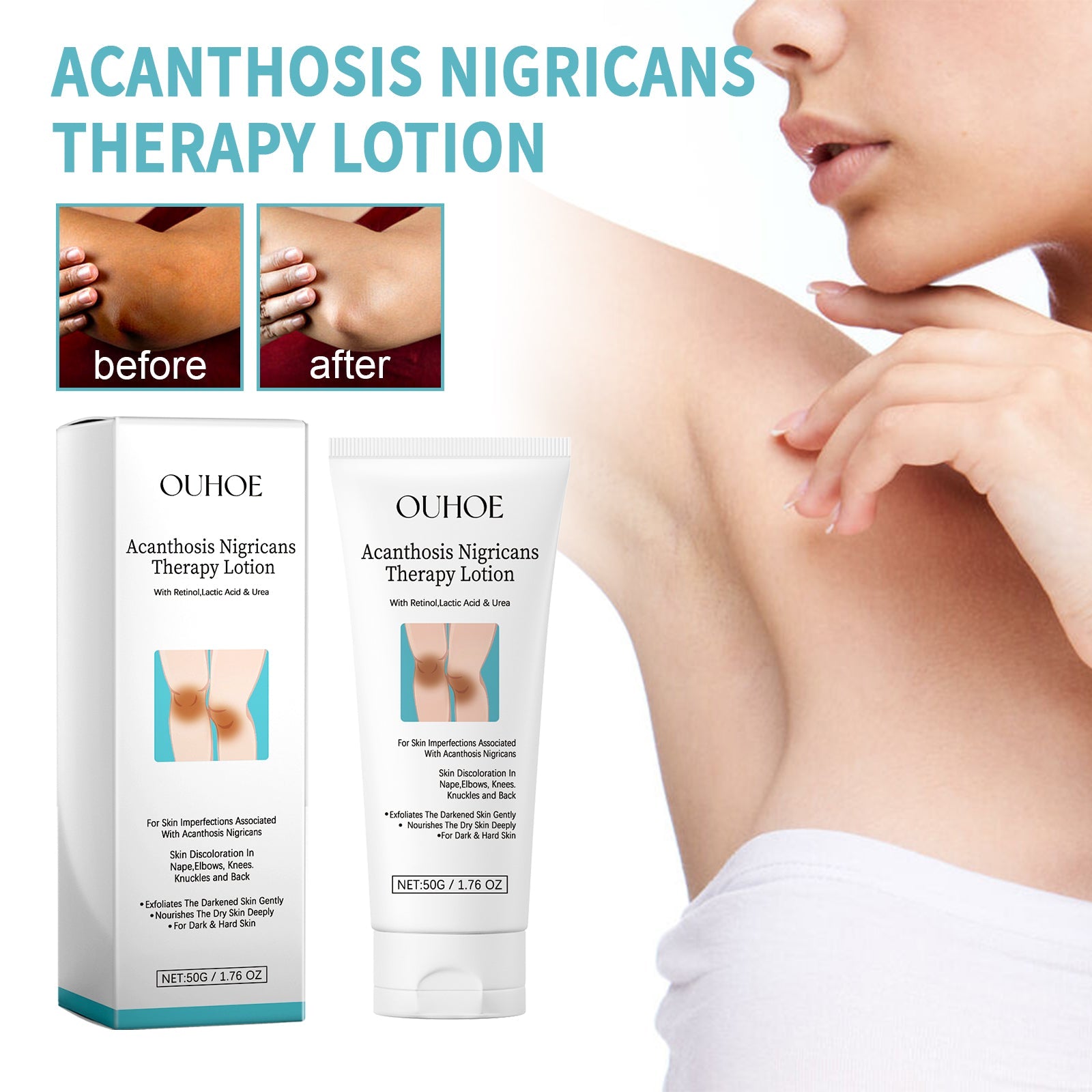 Acanthosis Nigricans Therapy Lotion, Skin Moisturizing Clean Black Dark Heavy Alar Knee Joint Repair Carry Bright Color Of Skin - Korvel