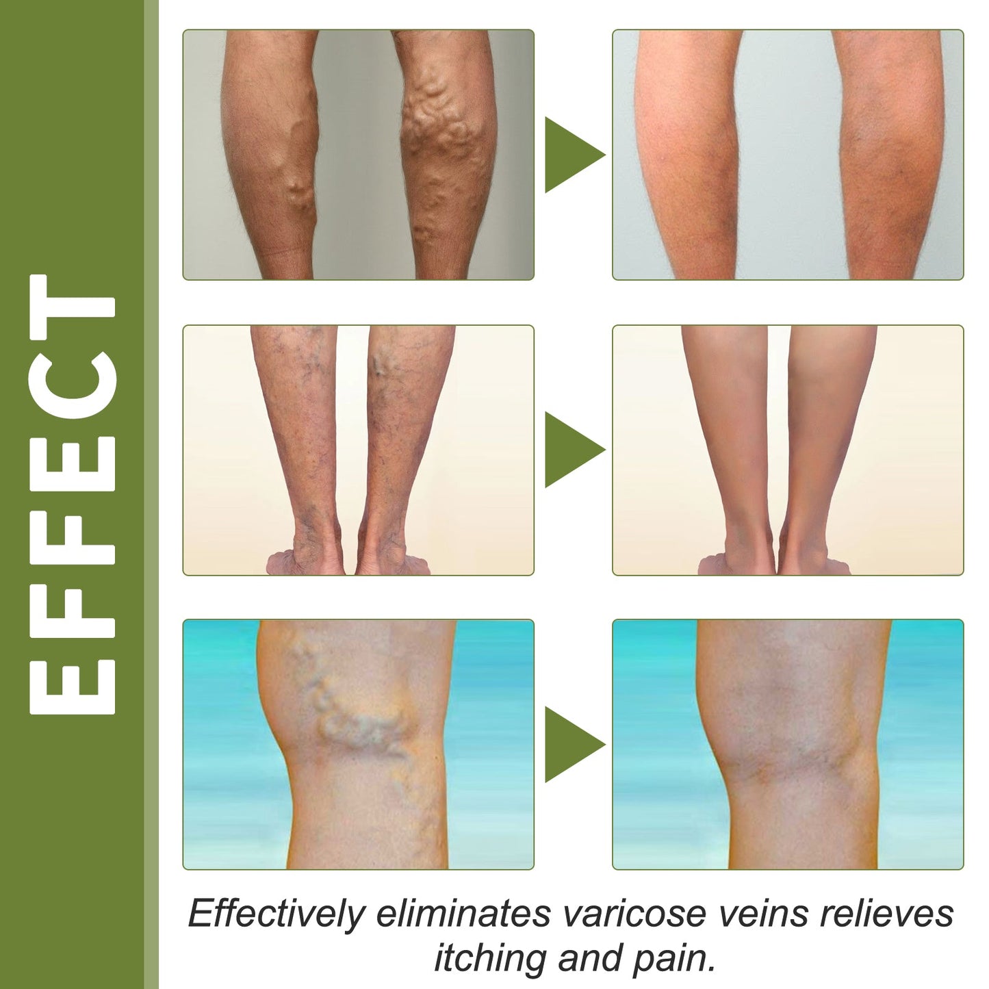 Crema Premium para Terapia de Venas para el Cuidado de las Piernas