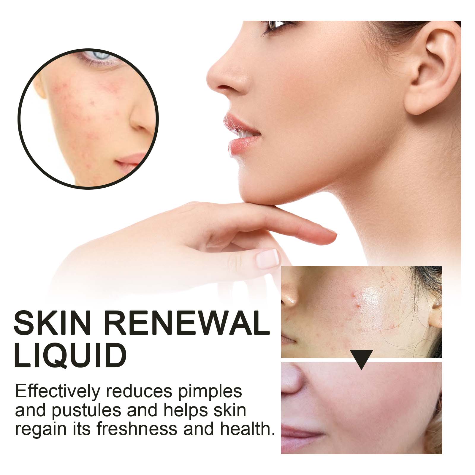 Skin Renewal Liquid, Reduce Acne Print Repair Acne Muscle Mild Clear Acne Hydrating Essence - Korvel