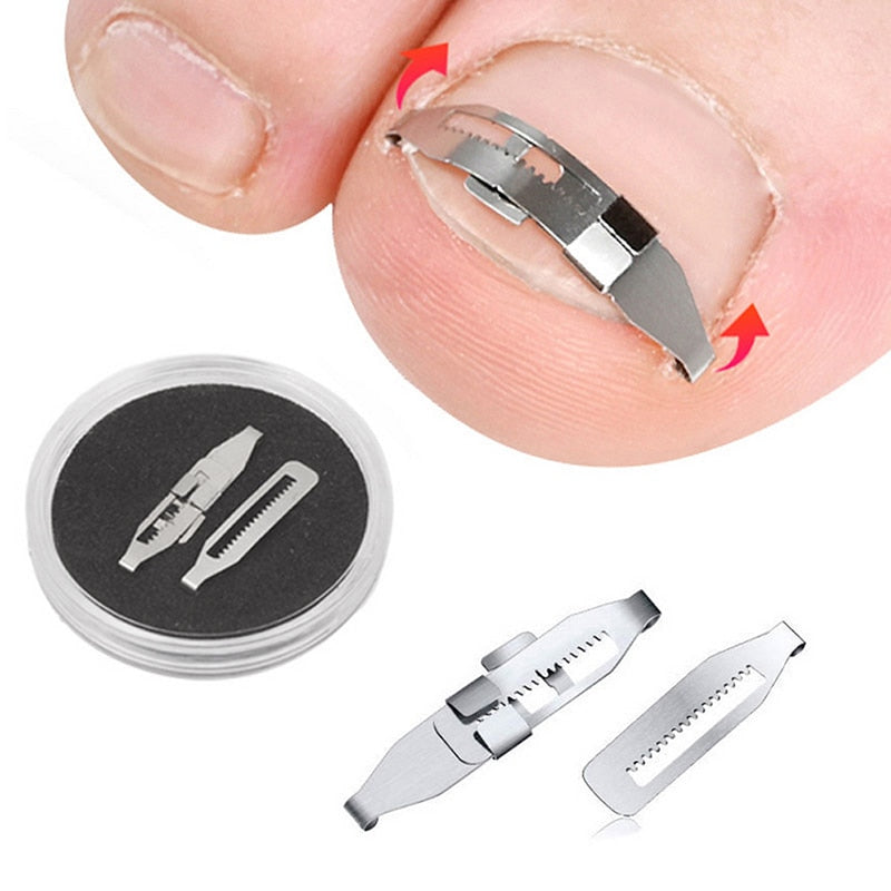 Ingrown Toenail Corrector Tools Pedicure Recover Embed Toe Nail Treatment Professional Ingrown Toenail Correction Foot Care Tool - Korvel