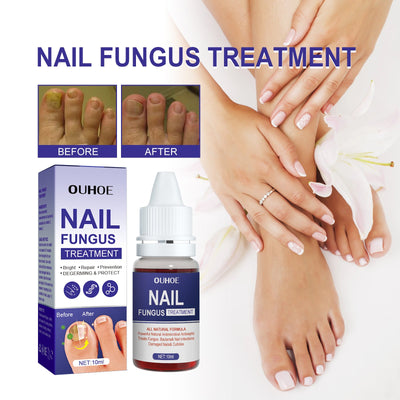 Nail Repair Lotion, Repair Thickening Nail Inlay Gray Nail Shine Soft Nail Care Solution - Korvel