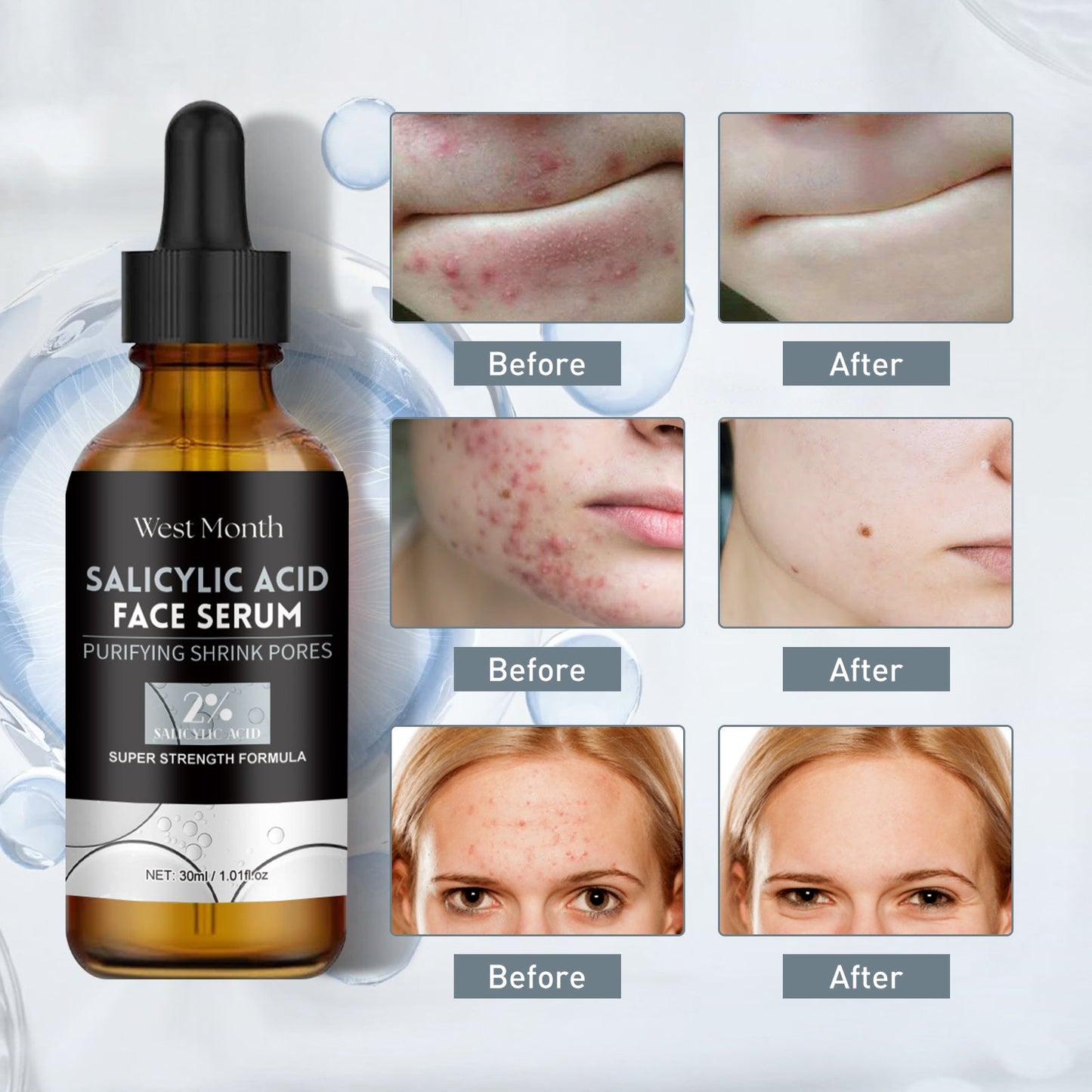 Salicylic Acid Facial Essence, Lighten Acne Mark Repair Hydrating Facial Care Essence - Korvel