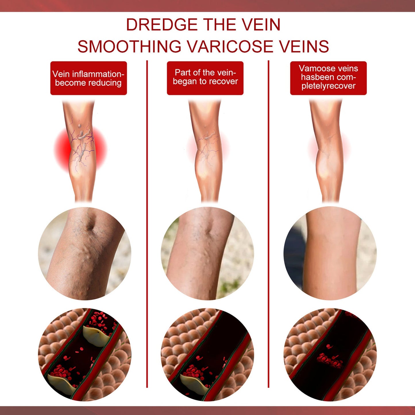 Aricose Veins Medical Cream, Relieve Leg Swelling Earthworm Leg Vein Massage To Relieve Pain - Korvel