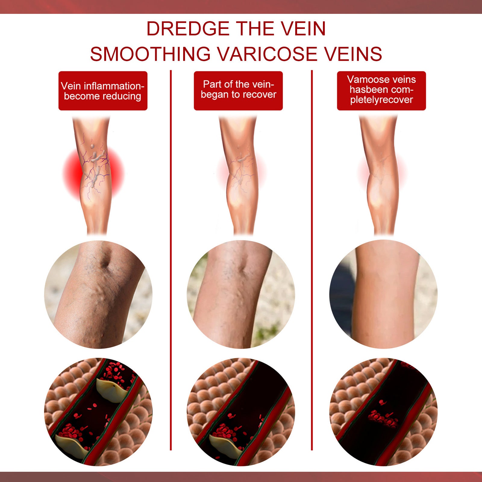 Aricose Veins Medical Cream, Relieve Leg Swelling Earthworm Leg Vein Massage To Relieve Pain - Korvel