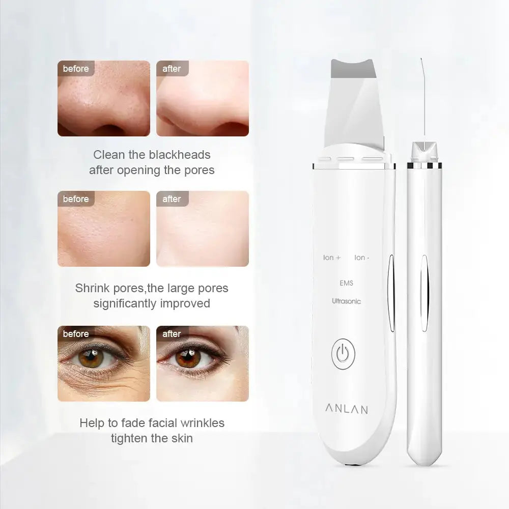 Appareil de levage de la peau par ultrasons